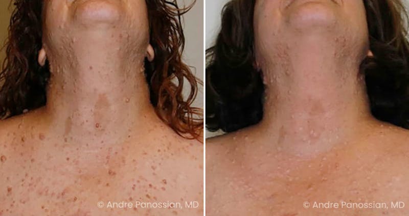 Neurofibromatosis Before & After Gallery - Patient 406106 - Image 1