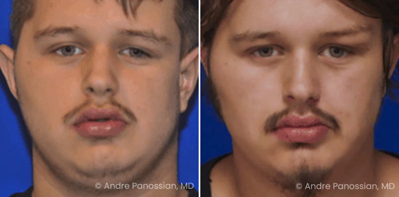 Smile Reanimation Before & After Gallery - Patient 944955 - Image 1