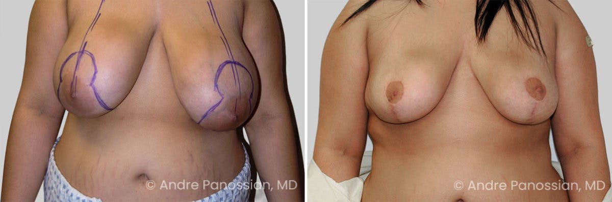 Breast Lift/Reduction Before & After Gallery - Patient 399263 - Image 1
