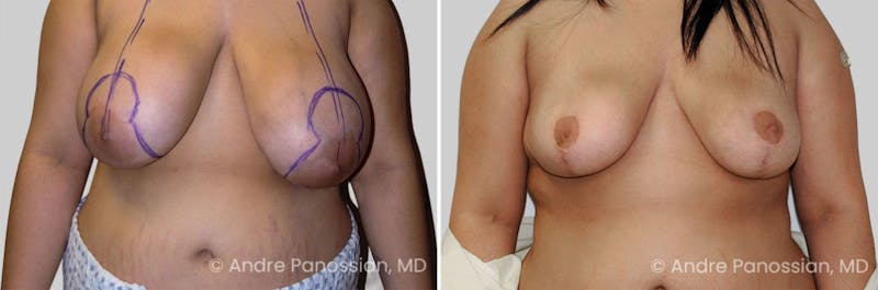 Breast Lift/Reduction Before & After Gallery - Patient 399263 - Image 1