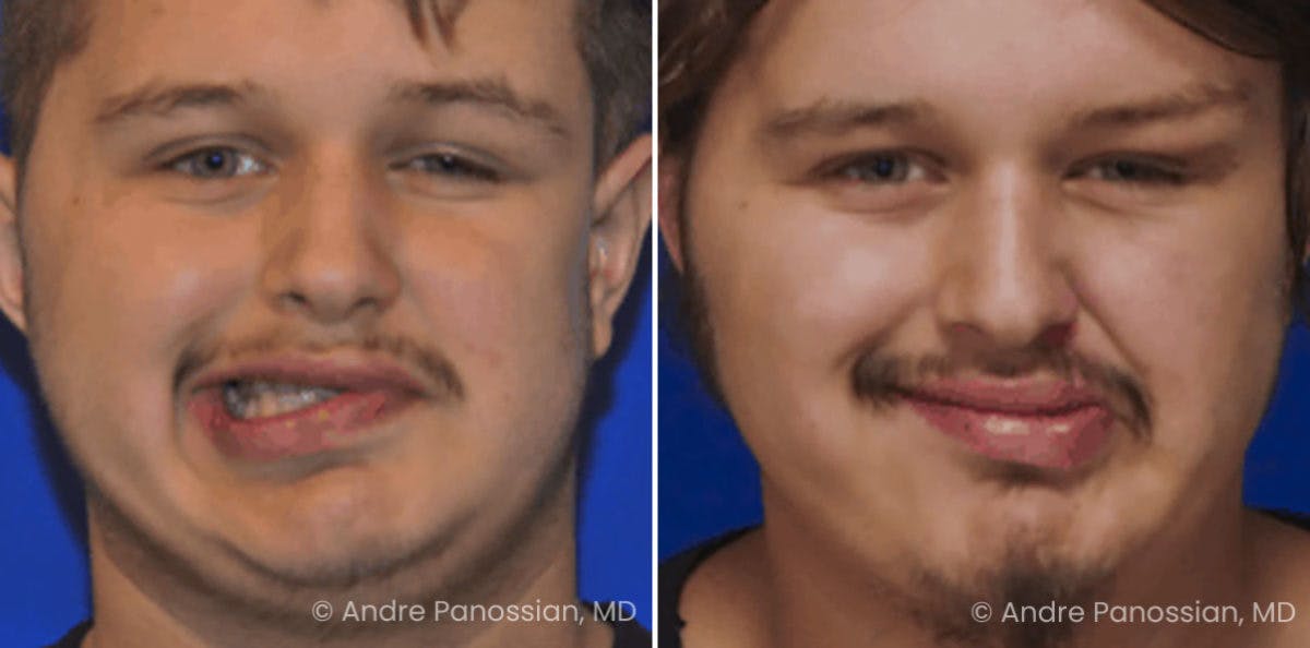 Smile Reanimation Before & After Gallery - Patient 944955 - Image 2