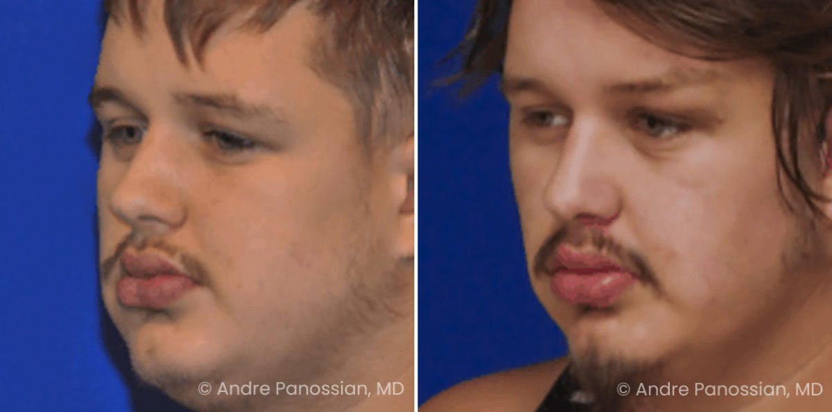 Smile Reanimation Before & After Gallery - Patient 944955 - Image 3