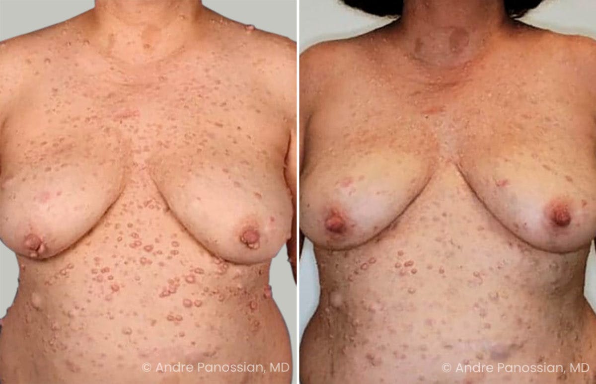 Neurofibromatosis Before & After Gallery - Patient 149521 - Image 1