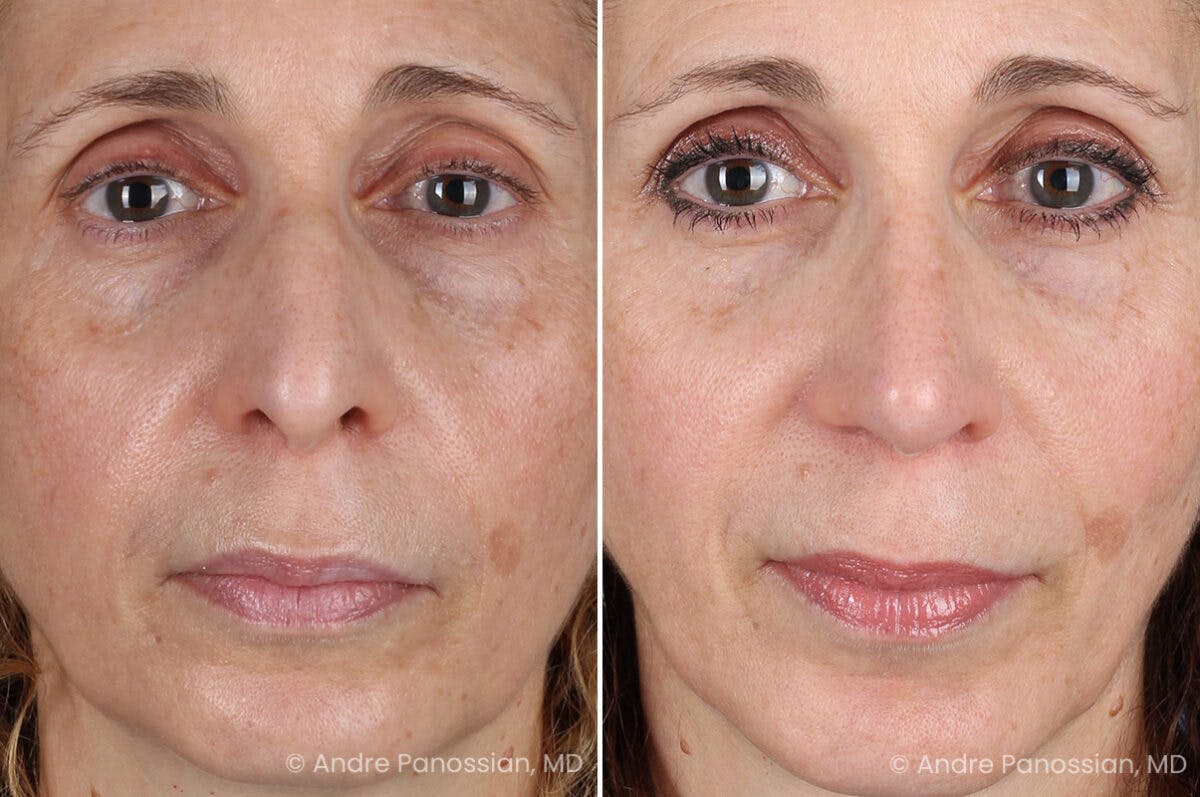 Rhinoplasty Before & After Gallery - Patient 385632 - Image 2