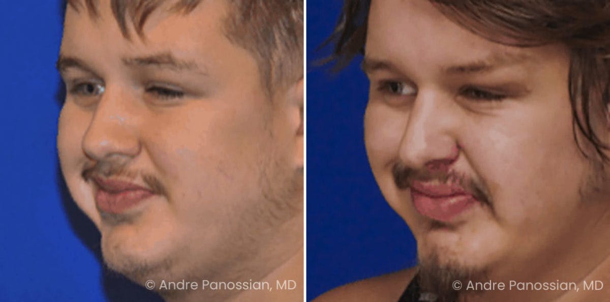 Smile Reanimation Before & After Gallery - Patient 944955 - Image 4