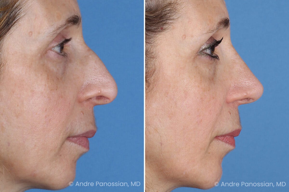 Rhinoplasty Before & After Gallery - Patient 385632 - Image 3