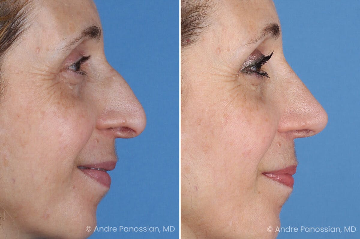 Rhinoplasty Before & After Gallery - Patient 385632 - Image 1