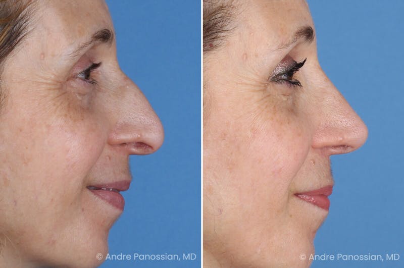 Rhinoplasty Before & After Gallery - Patient 385632 - Image 1