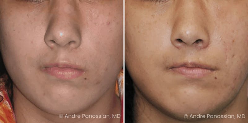 Smile Reanimation Before & After Gallery - Patient 237986 - Image 1