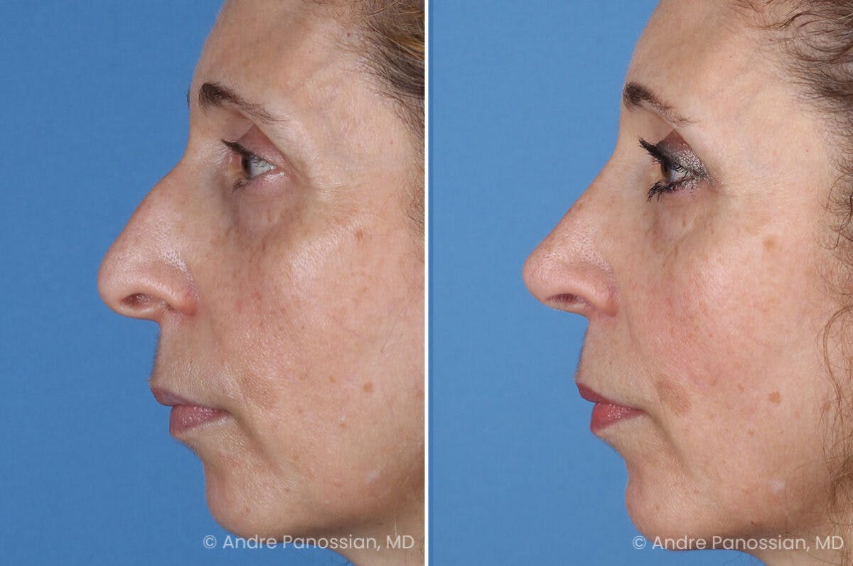 Rhinoplasty Before & After Gallery - Patient 385632 - Image 5