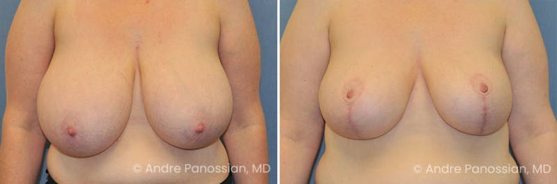 Breast Lift/Reduction Before & After Gallery - Patient 491610 - Image 1