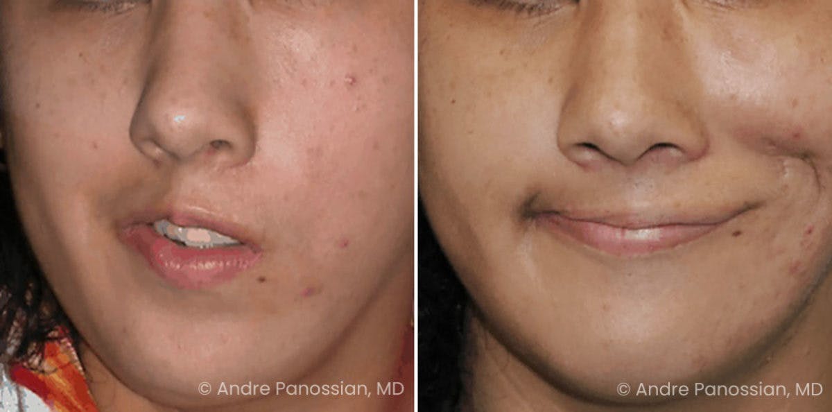 Smile Reanimation Before & After Gallery - Patient 237986 - Image 2