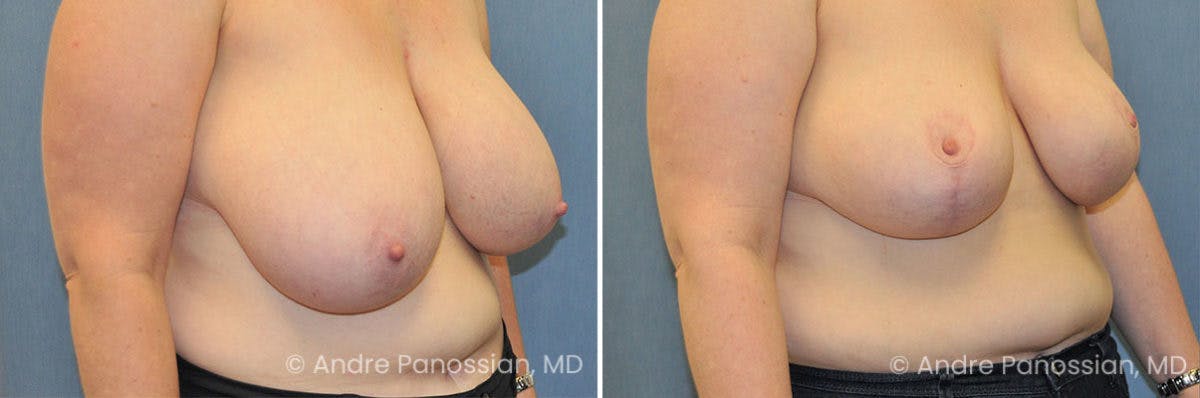 Breast Lift/Reduction Before & After Gallery - Patient 491610 - Image 2