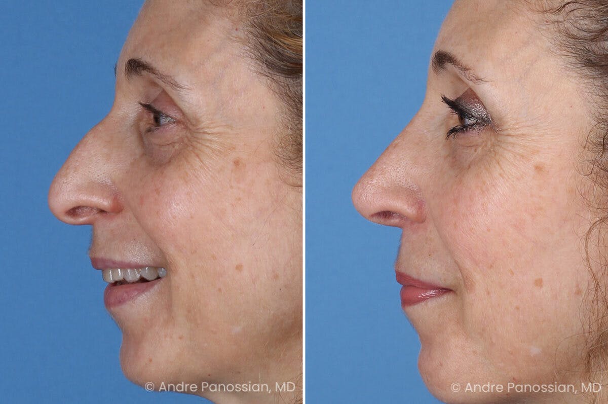 Rhinoplasty Before & After Gallery - Patient 385632 - Image 6