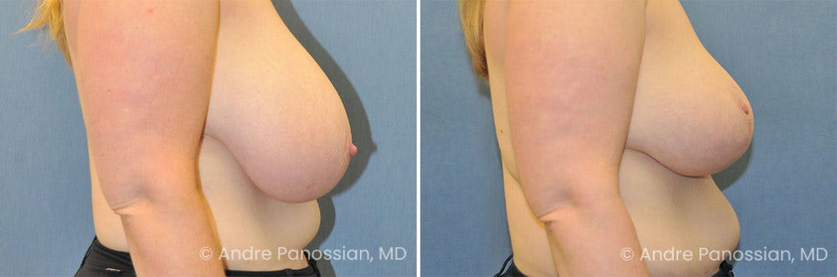 Breast Lift/Reduction Before & After Gallery - Patient 491610 - Image 3