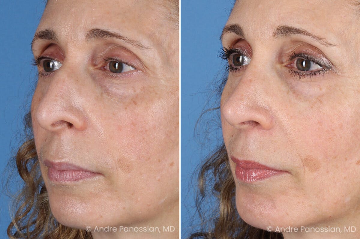 Rhinoplasty Before & After Gallery - Patient 385632 - Image 7
