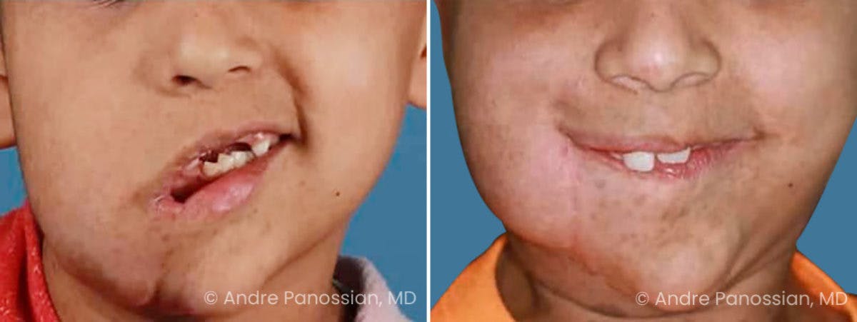 Neurofibromatosis Before & After Gallery - Patient 234345 - Image 1