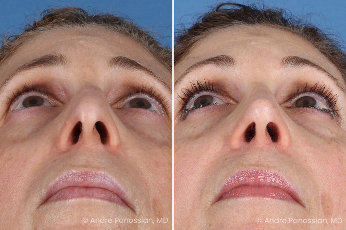 Rhinoplasty Before & After Gallery - Patient 385632 - Image 8