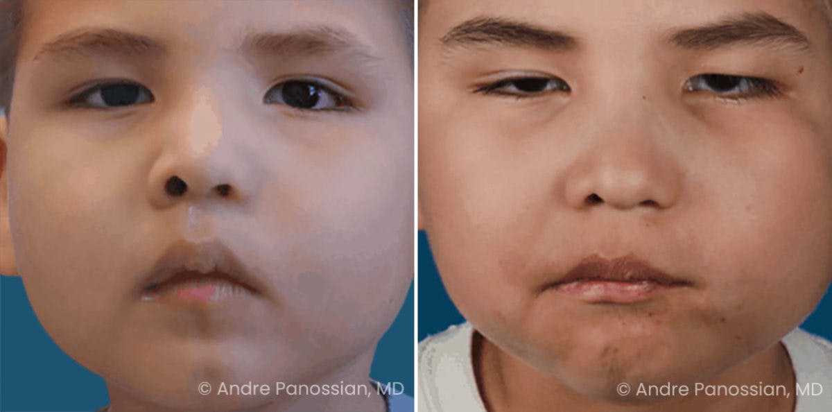 Smile Reanimation Before & After Gallery - Patient 174142 - Image 1