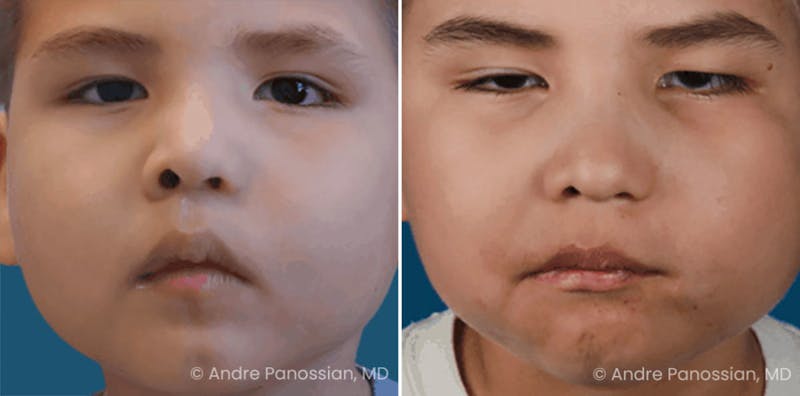 Smile Reanimation Before & After Gallery - Patient 174142 - Image 1