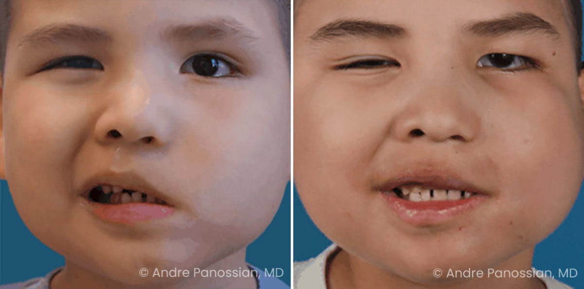Smile Reanimation Before & After Gallery - Patient 174142 - Image 2