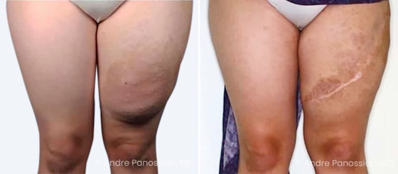 Neurofibroma removal & reconstruction before and after — actual patient of Andre Panossian, MD