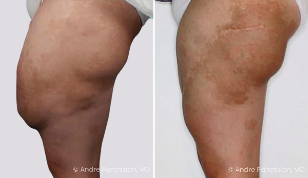Neurofibromatosis Before & After Gallery - Patient 736871 - Image 2