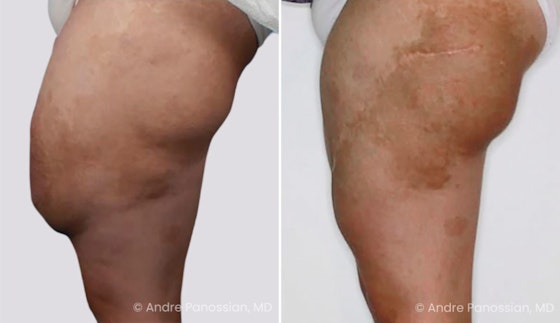 Neurofibroma removal & reconstruction before and after — actual patient of Andre Panossian, MD