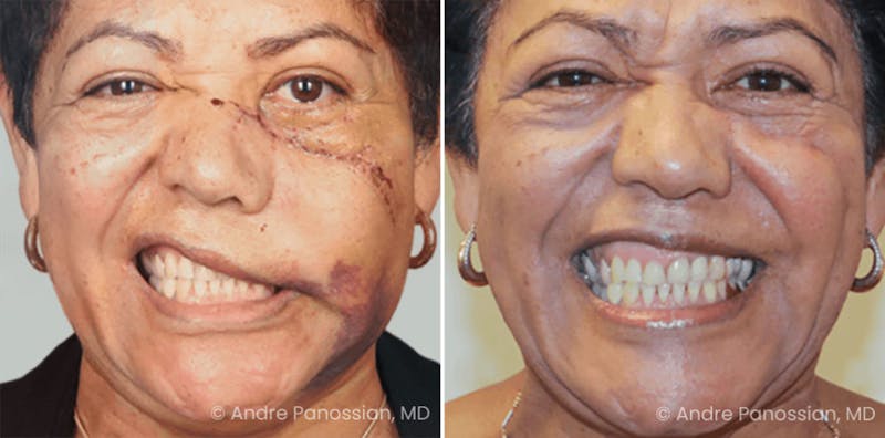 Smile Reanimation Before & After Gallery - Patient 127855 - Image 1