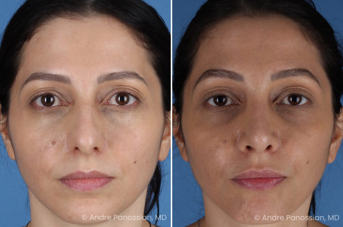 Rhinoplasty Before & After Gallery - Patient 105579 - Image 2