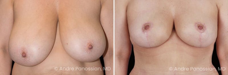 Breast Lift/Reduction Before & After Gallery - Patient 119816 - Image 1