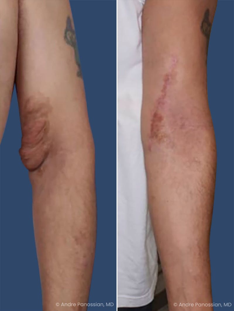 Neurofibromatosis Before & After Gallery - Patient 343775 - Image 1
