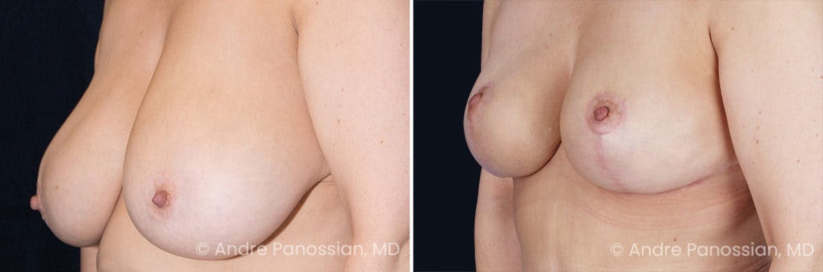 Breast Lift/Reduction Before & After Gallery - Patient 119816 - Image 2