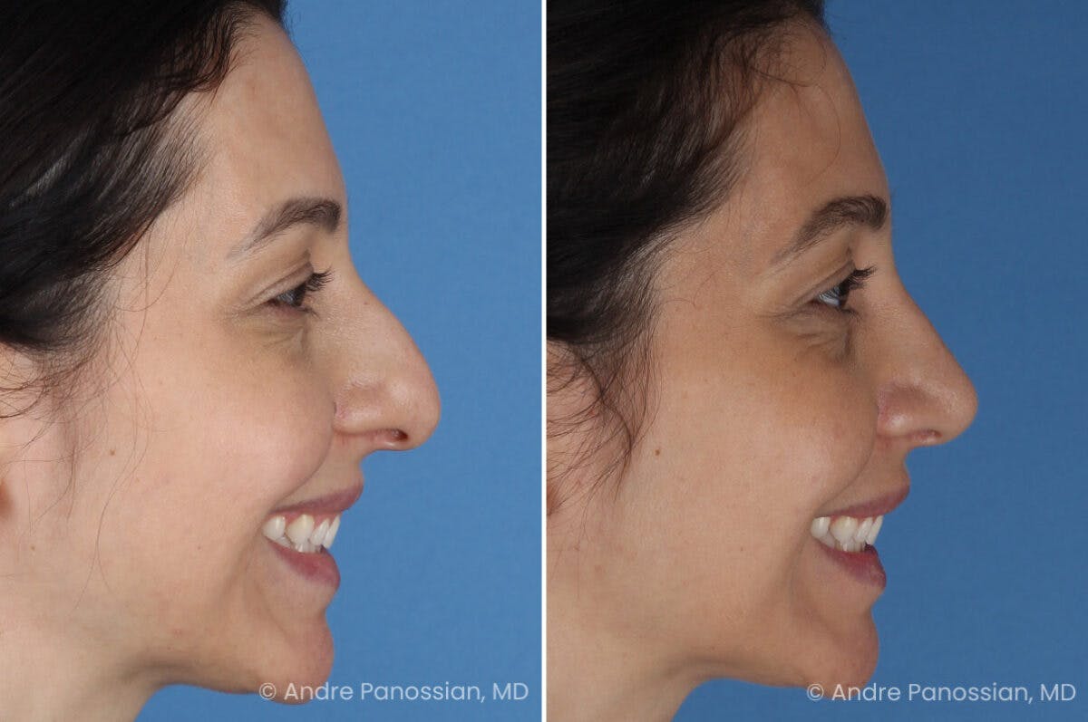 Rhinoplasty Before & After Gallery - Patient 105579 - Image 1