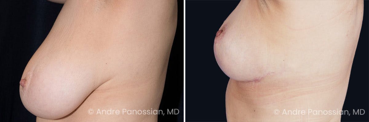 Breast Lift/Reduction Before & After Gallery - Patient 119816 - Image 3