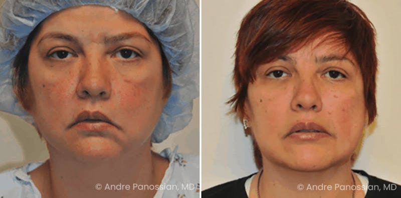 Smile Reanimation Before & After Gallery - Patient 333428 - Image 1