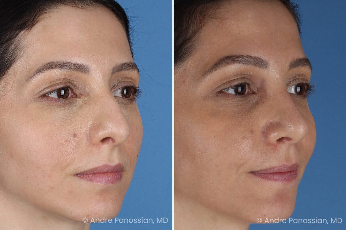 Rhinoplasty Before & After Gallery - Patient 105579 - Image 4