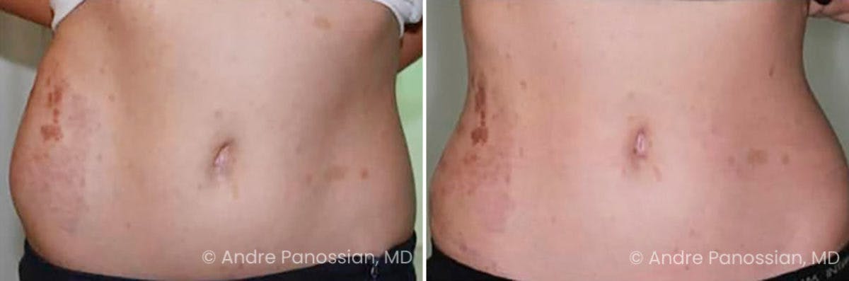 Neurofibromatosis Before & After Gallery - Patient 421209 - Image 1