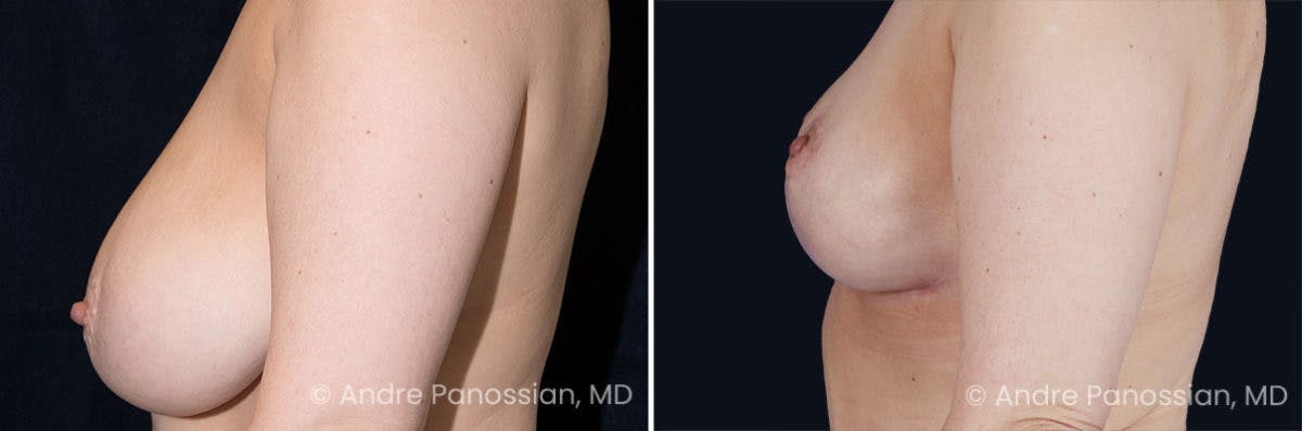Breast Lift/Reduction Before & After Gallery - Patient 119816 - Image 4