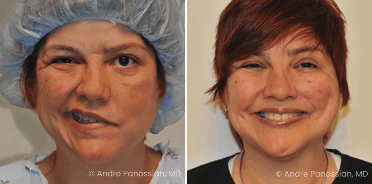 Smile Reanimation Before & After Gallery - Patient 333428 - Image 2