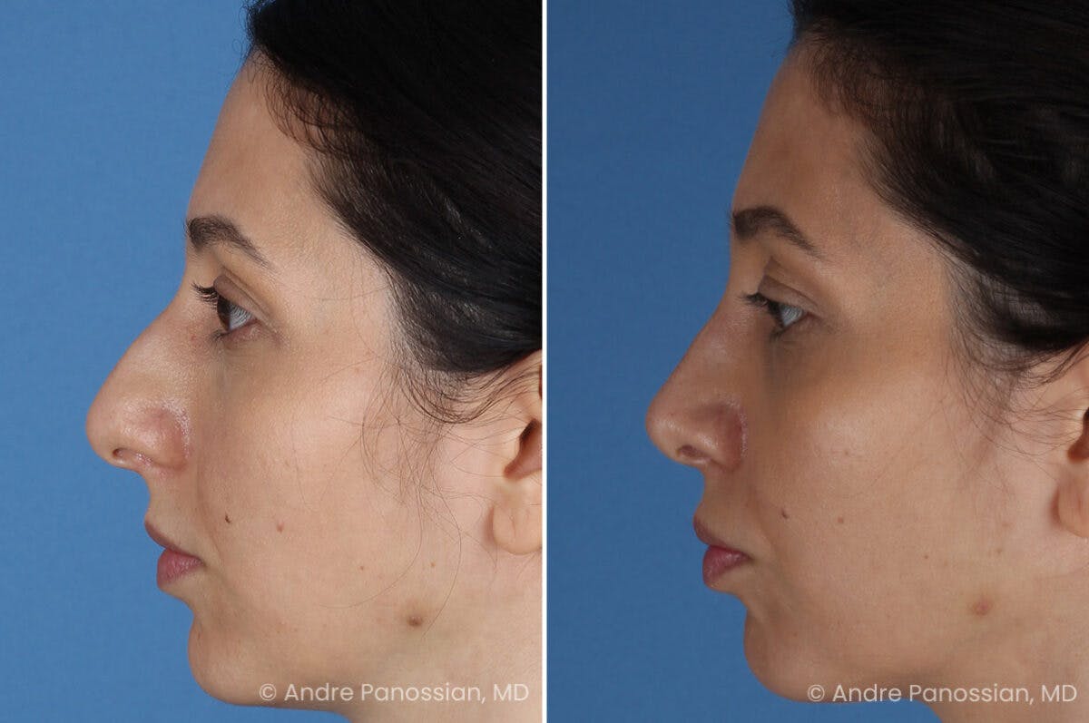 Rhinoplasty Before & After Gallery - Patient 105579 - Image 5