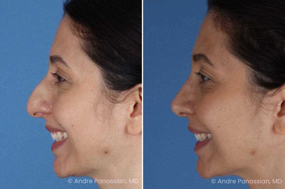 Rhinoplasty Before & After Gallery - Patient 105579 - Image 6