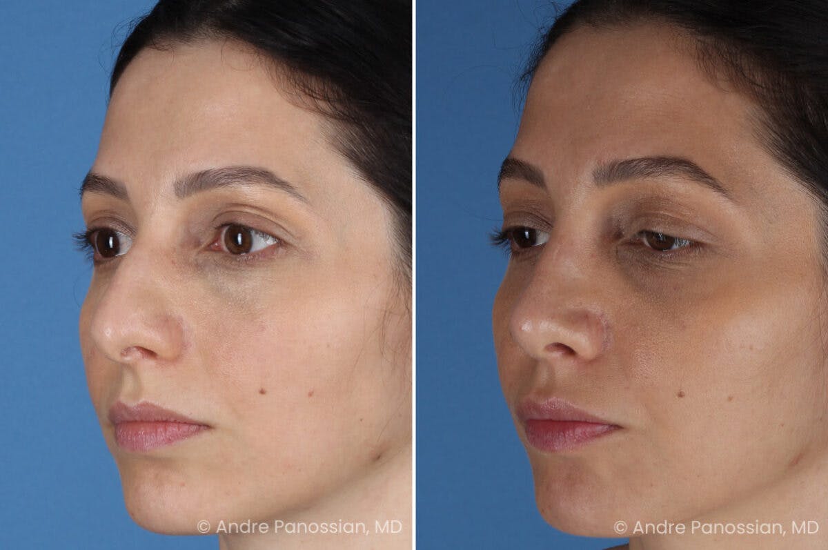 Rhinoplasty Before & After Gallery - Patient 105579 - Image 7