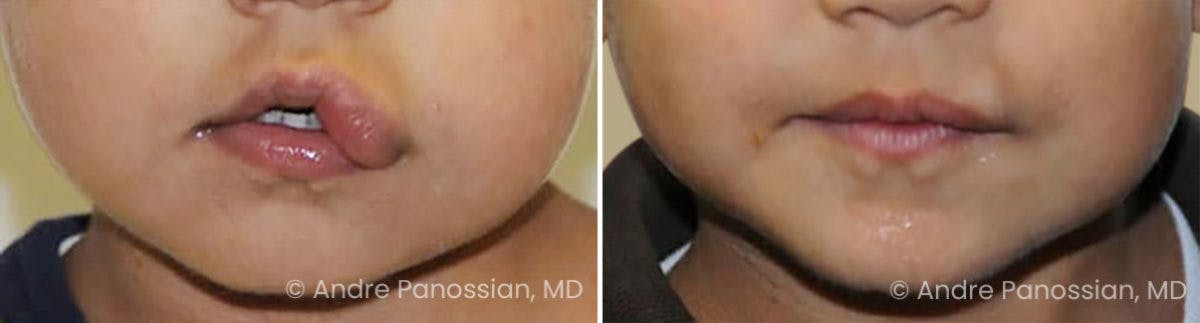 Neurofibromatosis Before & After Gallery - Patient 356025 - Image 1