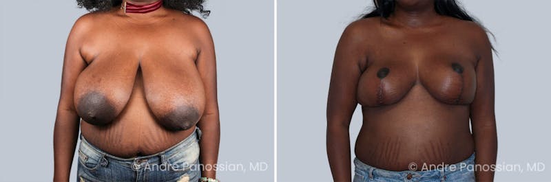 Breast Lift/Reduction Before & After Gallery - Patient 574716 - Image 1