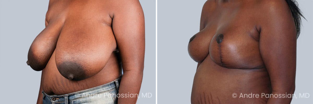 Breast Lift/Reduction Before & After Gallery - Patient 574716 - Image 2