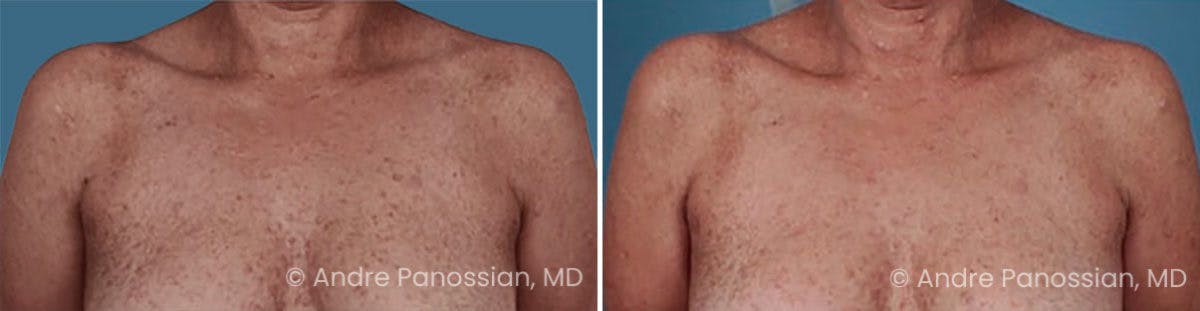 Neurofibromatosis Before & After Gallery - Patient 151400 - Image 1