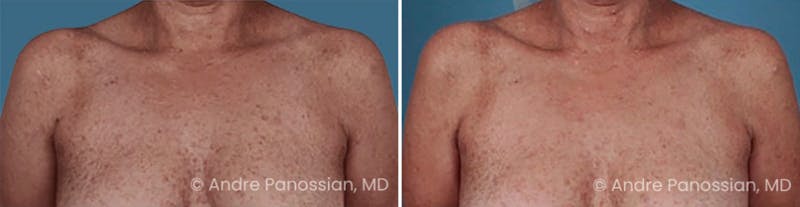 Neurofibromatosis Before & After Gallery - Patient 151400 - Image 1