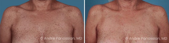 Neurofibroma removal & reconstruction before and after — actual patient of Andre Panossian, MD