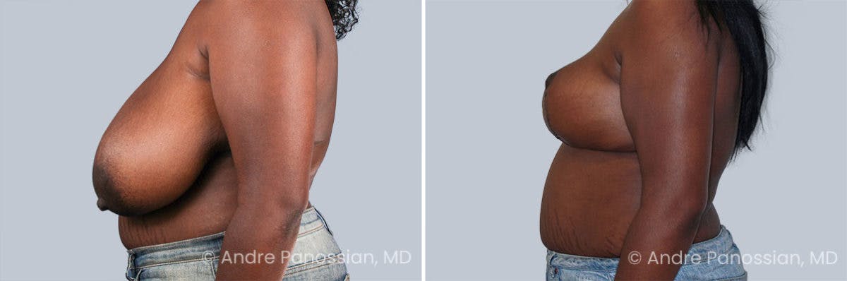 Breast Lift/Reduction Before & After Gallery - Patient 574716 - Image 3